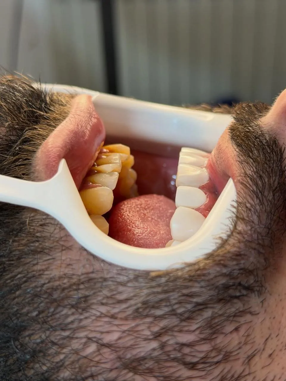 نمونه کامپوزیت دندادن رشت 1