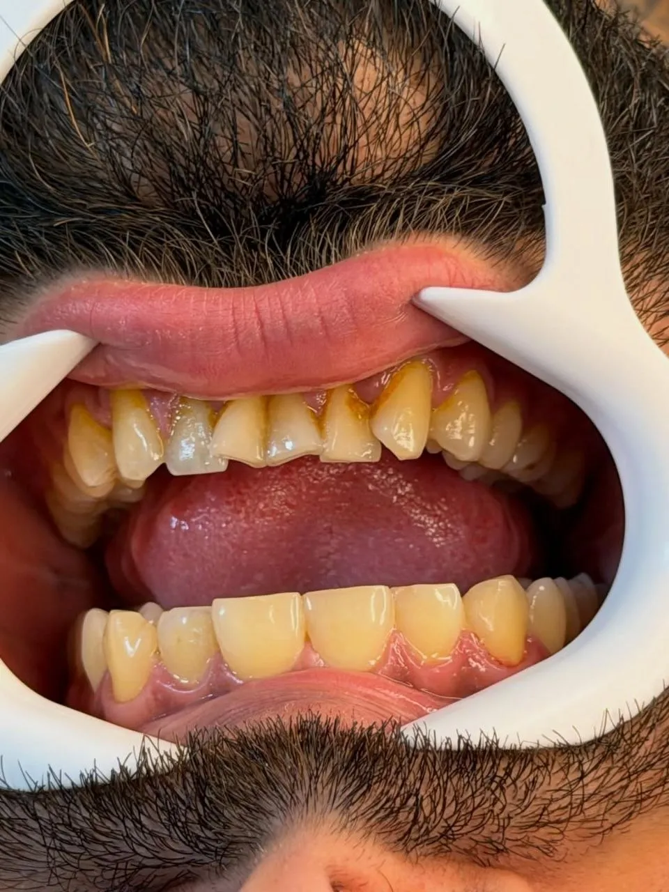 نمونه کامپوزیت دندادن رشت 3