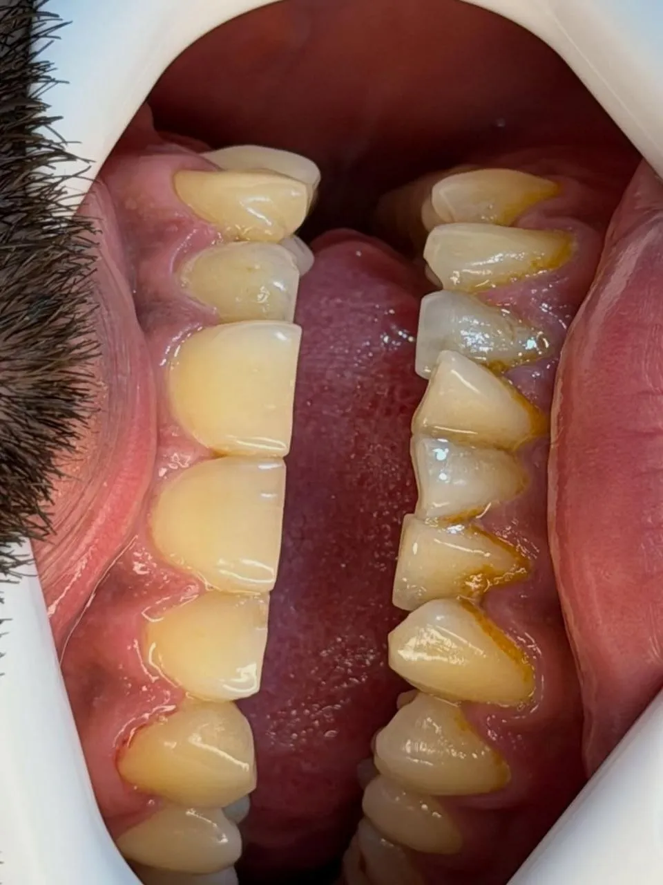 نمونه کامپوزیت دندادن رشت 4