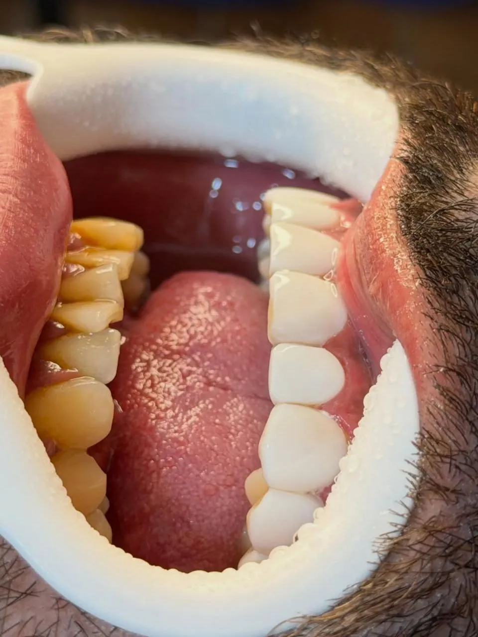 نمونه کامپوزیت دندادن رشت 5